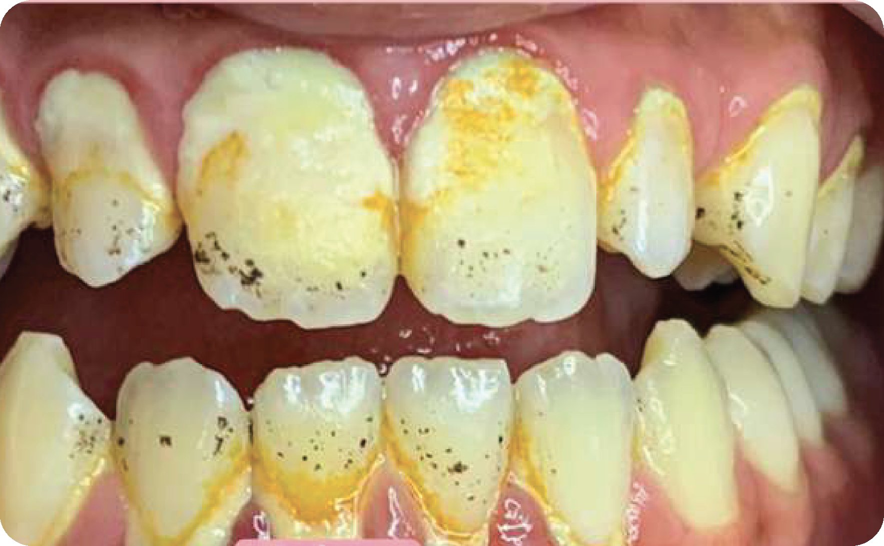 Scaling - Maesa Dental Clinic | Klinik Gigi Terbaik