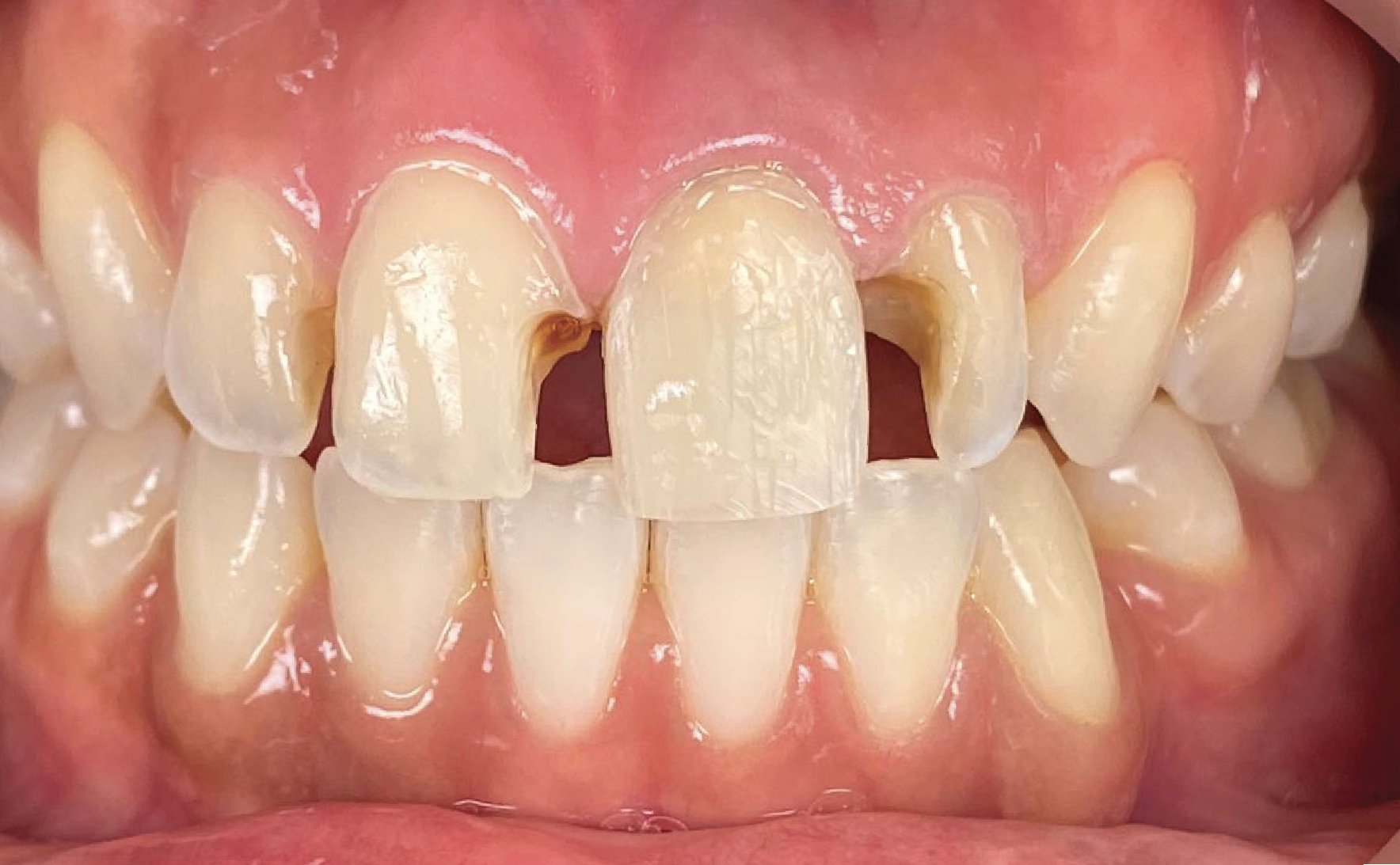 Direct Veneer - Maesa Dental Clinic | Klinik Gigi Terbaik