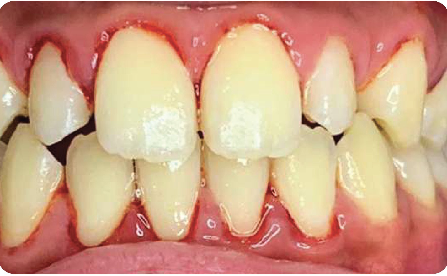 Scaling - Maesa Dental Clinic | Klinik Gigi Terbaik