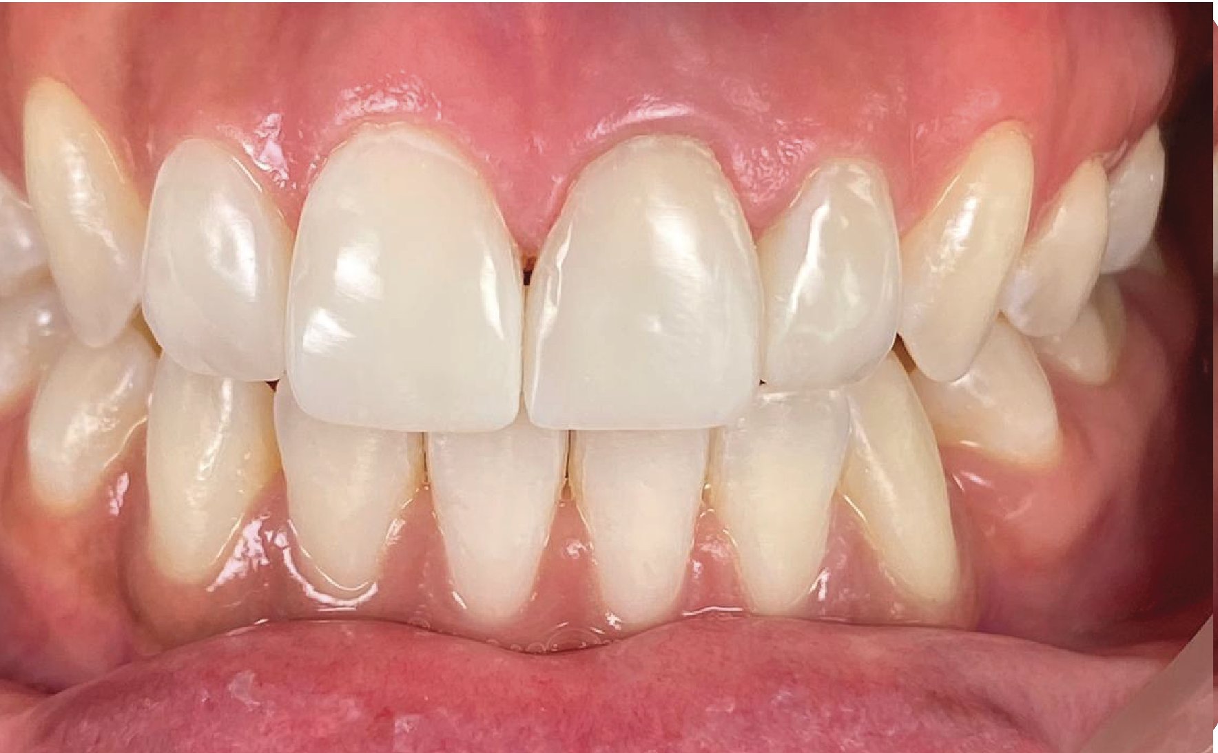 Direct Veneer - Maesa Dental Clinic | Klinik Gigi Terbaik