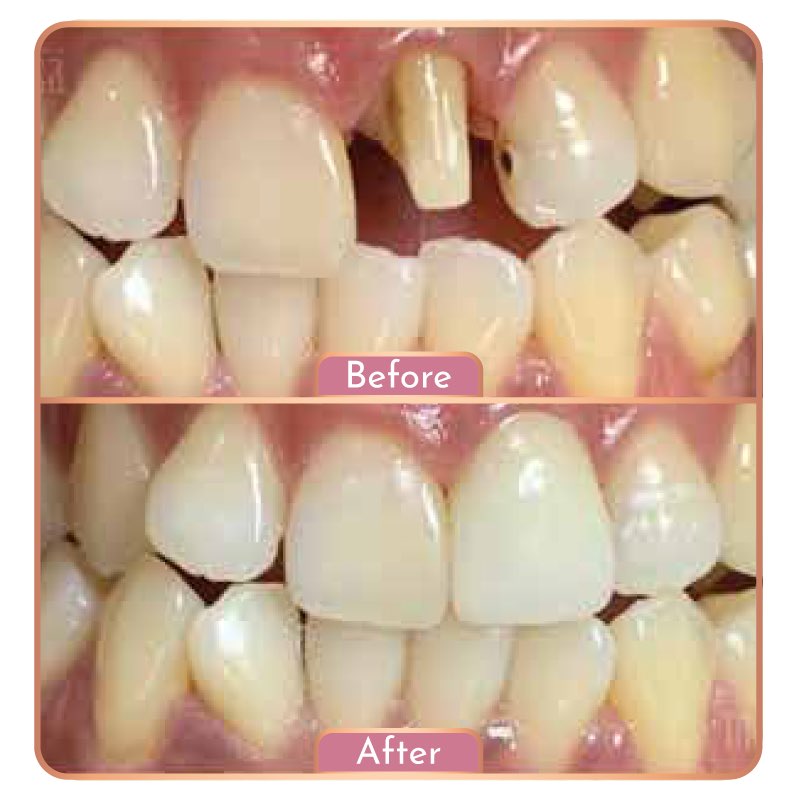 Gigi Palsu (Emax) - Maesa Dental Clinic | Klinik Gigi Terbaik