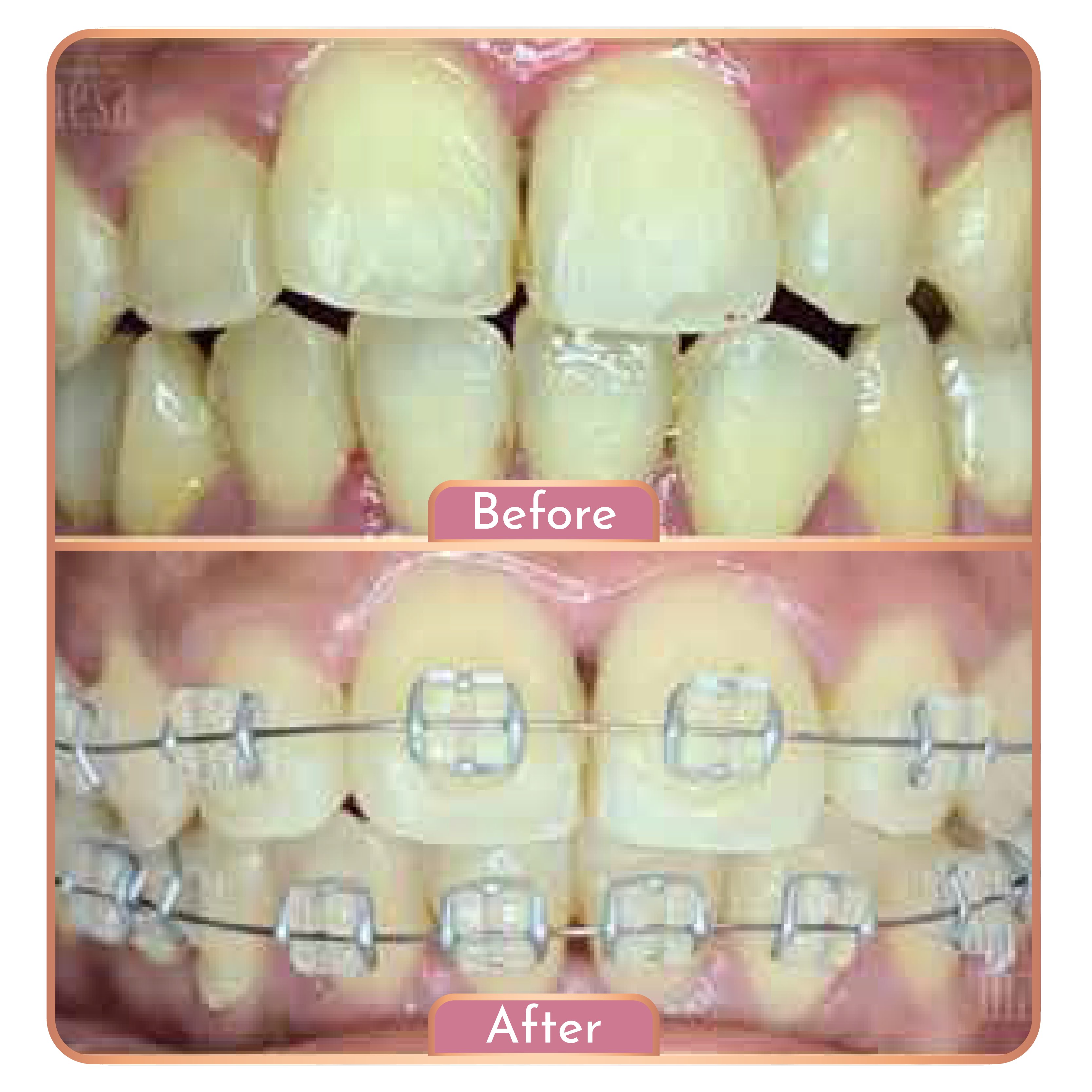 Behel gigi (Sapphire) - Maesa Dental Clinic | Klinik Gigi Terbaik